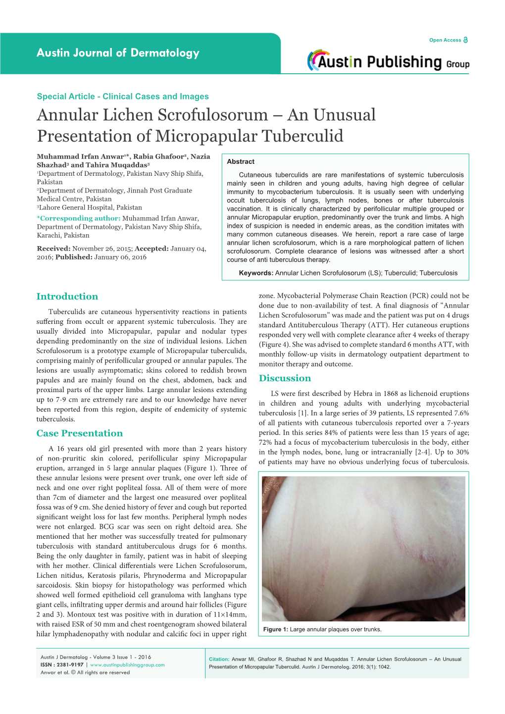 Annular Lichen Scrofulosorum – an Unusual Presentation of Micropapular Tuberculid