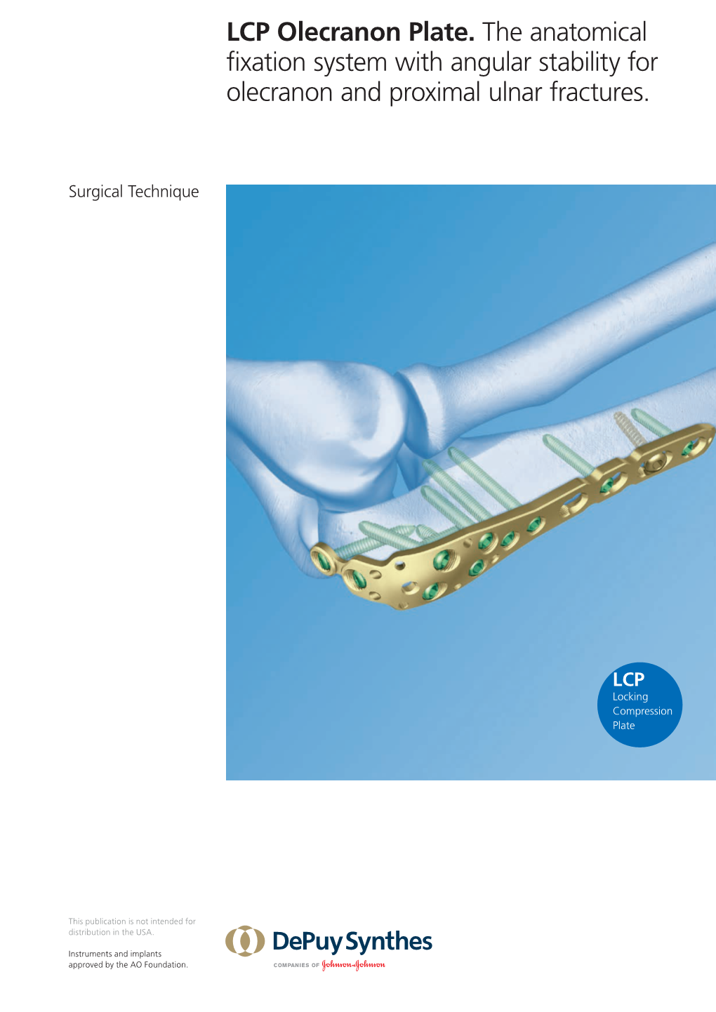 LCP Olecranon Plate. the Anatomical Fixation System with Angular Stability for Olecranon and Proximal Ulnar Fractures