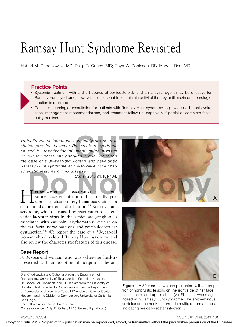 Ramsay Hunt Syndrome Revisited