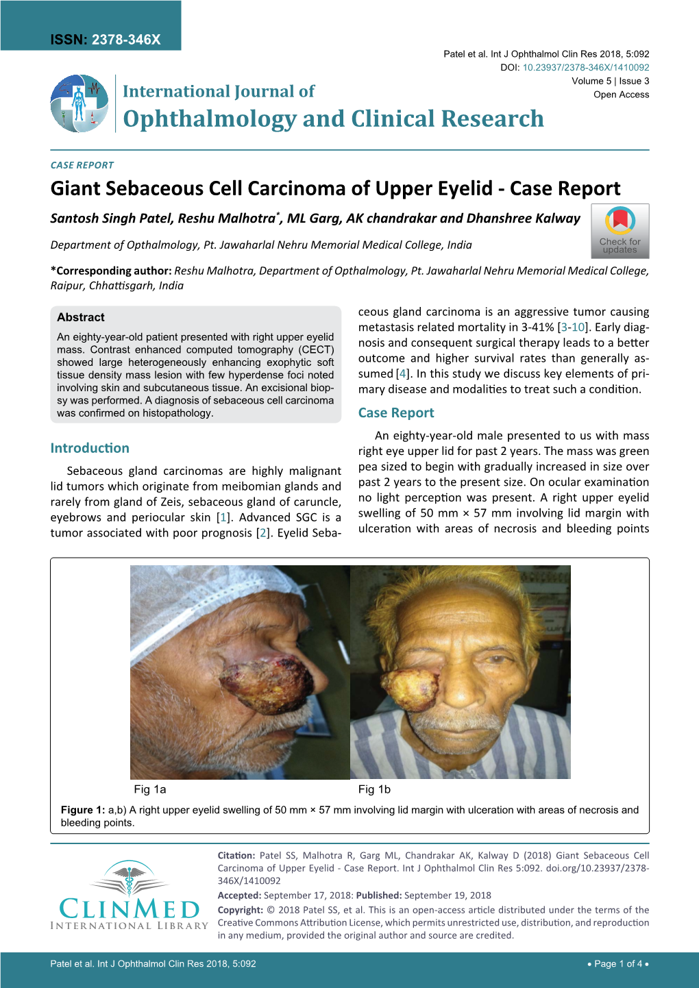 Giant Sebaceous Cell Carcinoma of Upper Eyelid - Case Report Santosh Singh Patel, Reshu Malhotra*, ML Garg, AK Chandrakar and Dhanshree Kalway