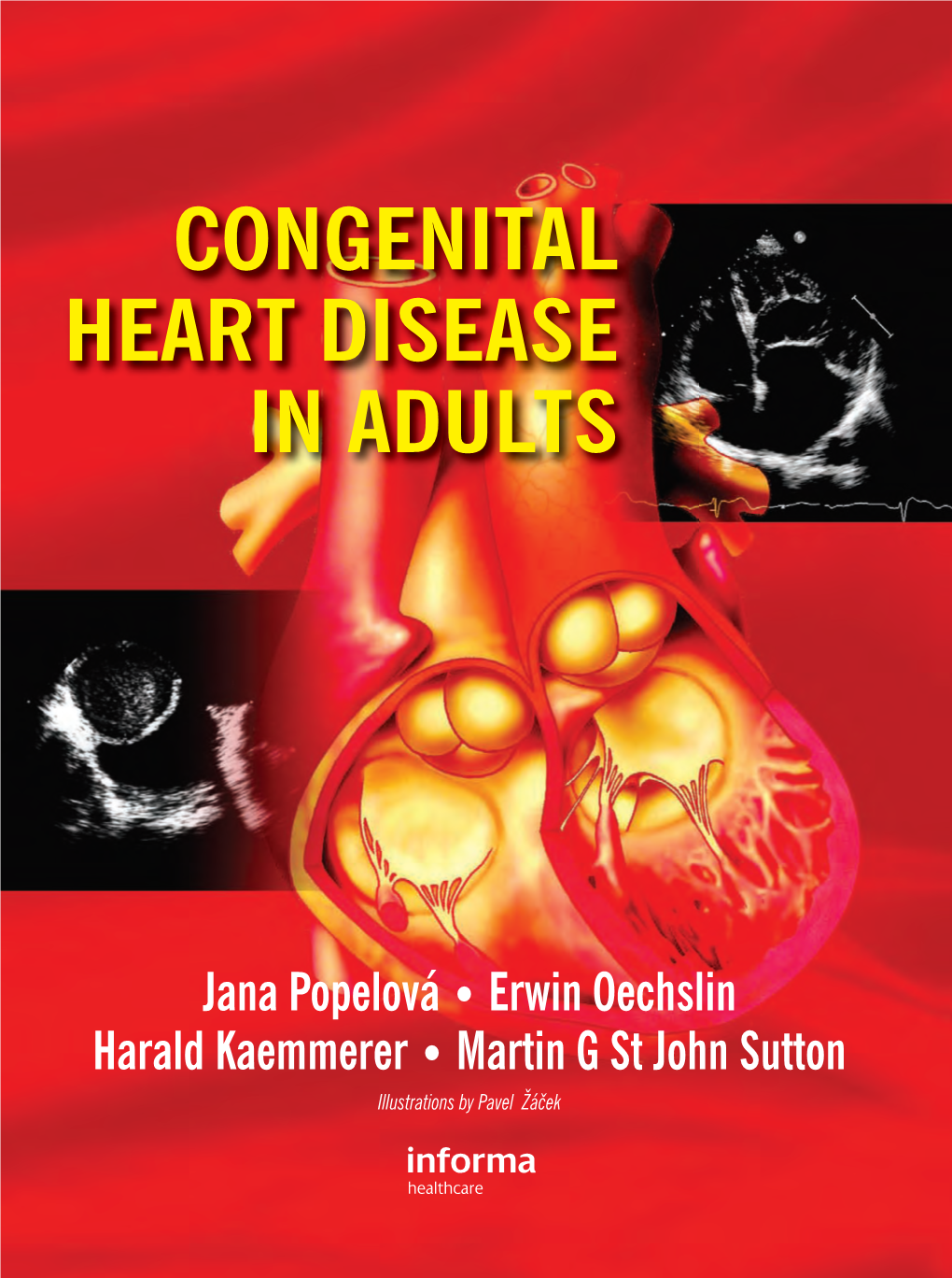 CONGENITAL HEART DISEASE in ADULTS • Oechslin