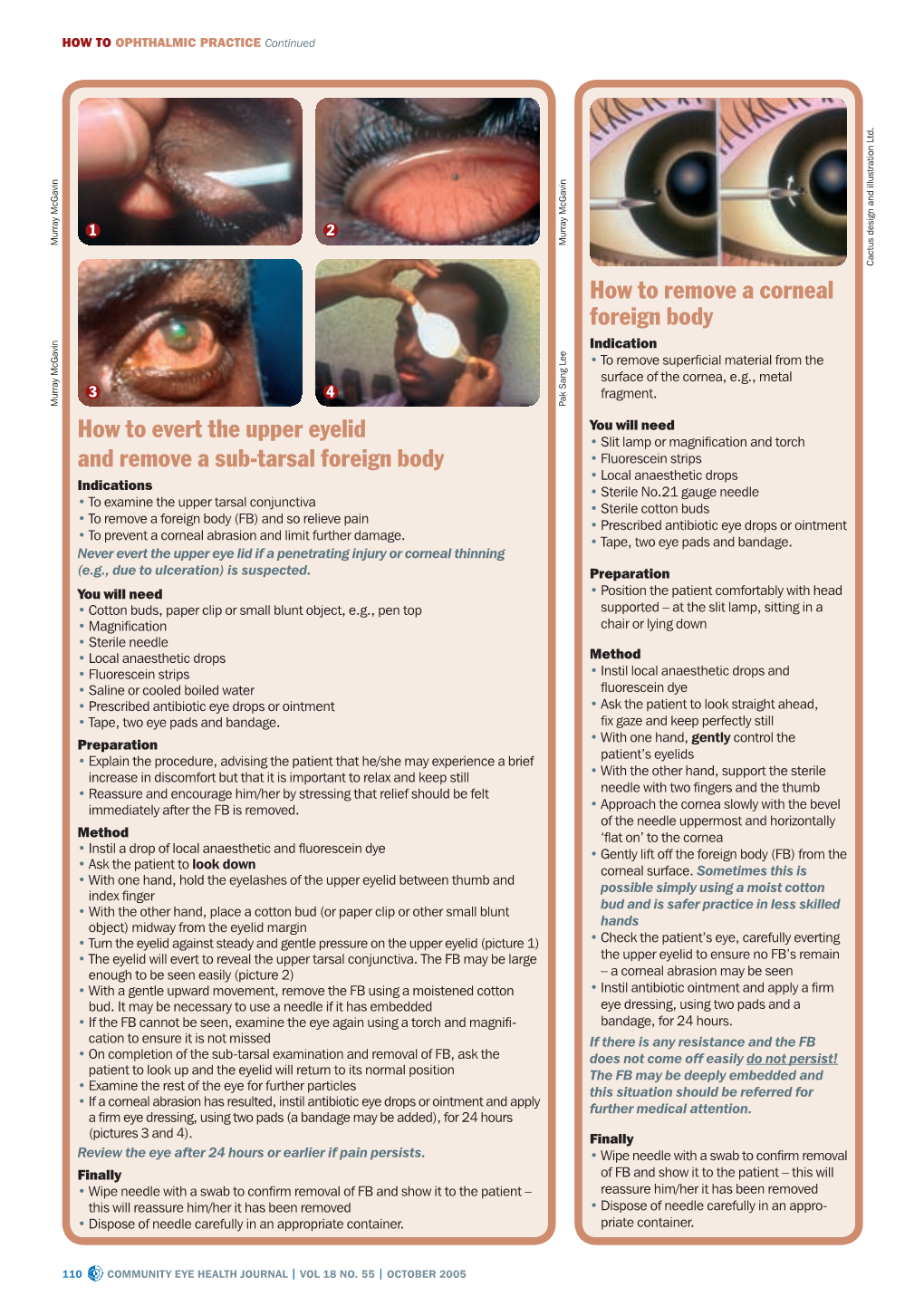 How to Evert the Upper Eyelid and Remove a Sub-Tarsal Foreign Body